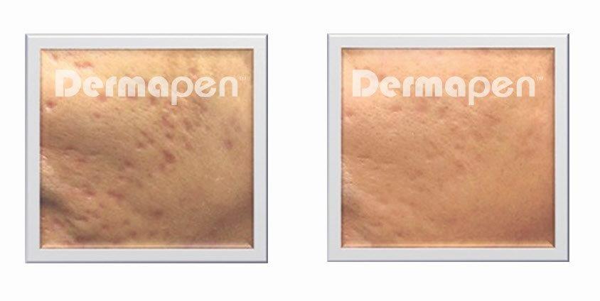 dermapen-akademiklinikken-Acne-Scarring-after5weeks treatments